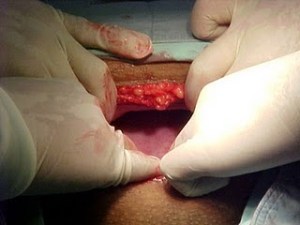 26+Abriendo+el+peritoneo+2