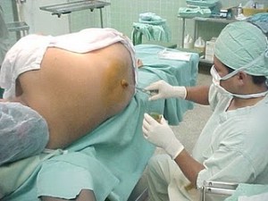 5+Preparando+el+área+lumbar